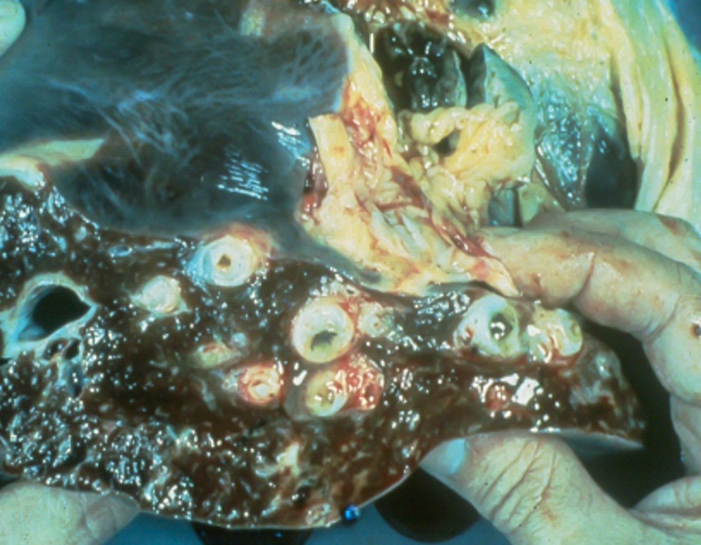 A liver damaged by flukes. 
